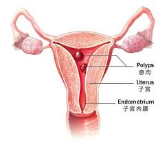子宫内膜癌的检查诊断方法